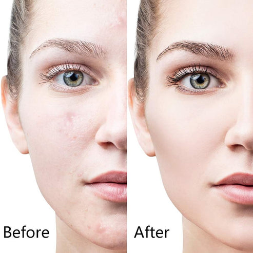 6-in-1 Derma Roller System